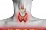  THẤU HIỂU BỆNH SUY GIÁP (Hypothyroidism)