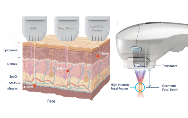 phương pháp trẻ hoá da bằng công nghệ HIFU