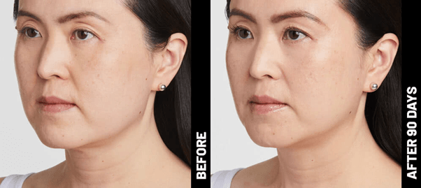 Giới thiệu về Ultherapy