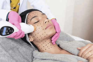 Thermage là công nghệ làm đẹp không xâm lấn nổi tiếng đến từ Mỹ