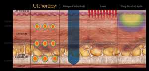 Ultherapy cách tác động nhiệt vào các vùng da cần điều trị.