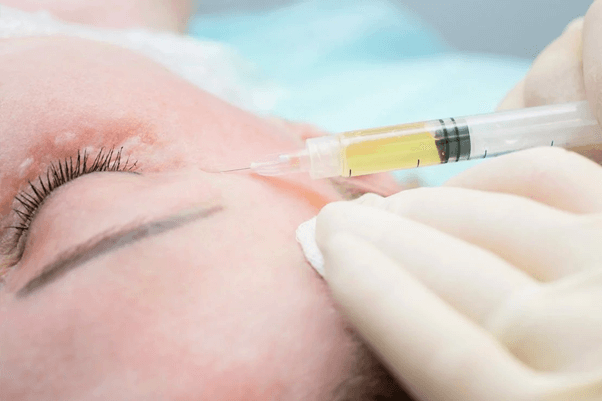 PRP – Huyết tương giàu tiểu cầu