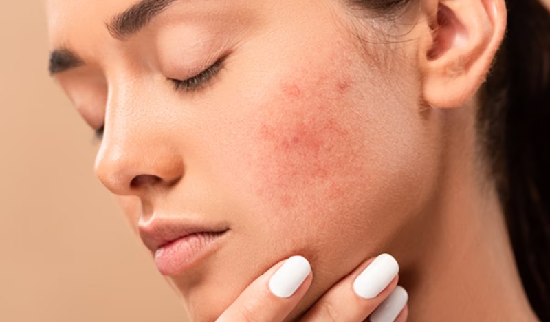 Xử lý da bị tổn thương do ánh nắng bằng các sản phẩm dịu nhẹ và tránh tiếp xúc với nắng
